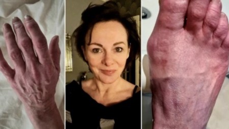 امرأة بريطانية تنشر صورة ليديها و كأنها  محروقة  بسبب كورونا